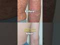 Say Goodbye to Psoriasis Forever #shorts