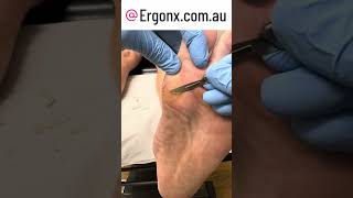 Forefoot Callus Cutting With A Scalpel In Podaitry Clinic