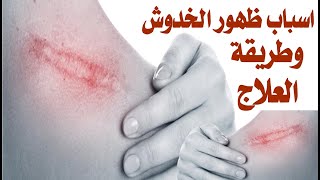 اسباب وعلاج الخدوش التى تظهر على الجسد هل تجد عند استياقظك من النوم خدوش بجسدك ولاتعلم سبب ذلك