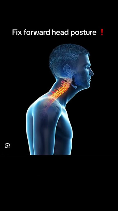 How to fix forward head posture (nerd neck)