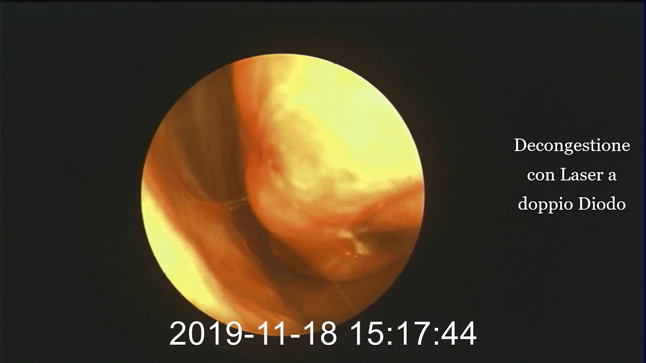 Intervento per ipertrofia dei Turbinati con Laser a Doppio Diodo YouTube Intervento per ipertrofia dei Turbinati con Laser a Doppio Diodo YouTube