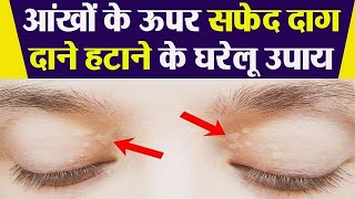आंखों के ऊपर जमा कोलेस्ट्रॉल को हटाने के पक्के घरेलू उपाय । Boldsky screenshot 4