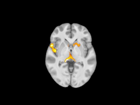 Video: Neuroimagistică Longitudinală și Profiluri Neuropsihologice Ale Demenței Frontotemporale Cu Expansiuni C9ORF72