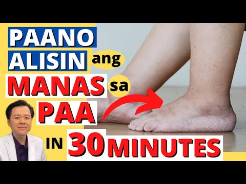 Paano Alisin ang Manas sa Paa in 30 minutes - Payo ni Doc Willie Ong
