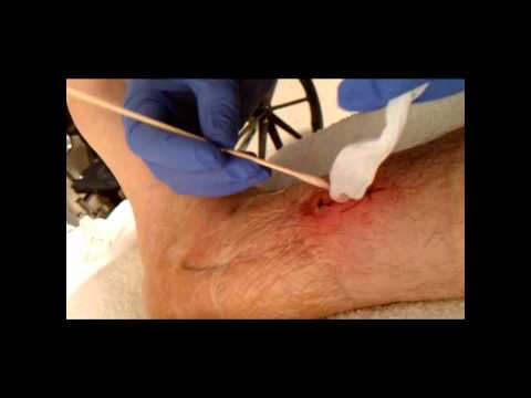 wound-care-packing