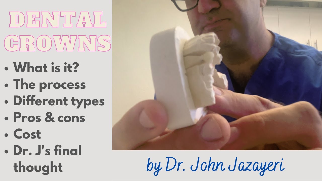 Dental Crown: What is it? +Pros & cons +Cost & More