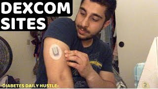 Where To Insert The Darn Dexcom! Diabetes Daily Vlog 352