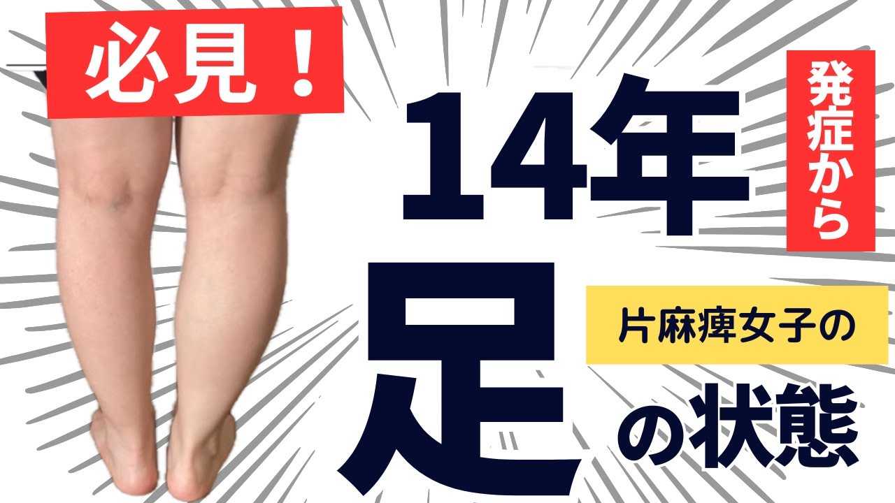 【必見！】発症から14年　片麻痺女子の足の状態～脳出血からの奇跡的な回復劇～