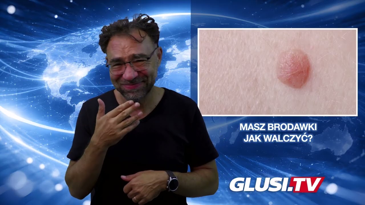 Masz brodawki - jak walczyć?