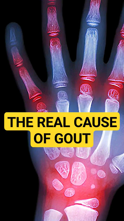 Here's Why You Have GOUT, And How To Fix It!   #gout
