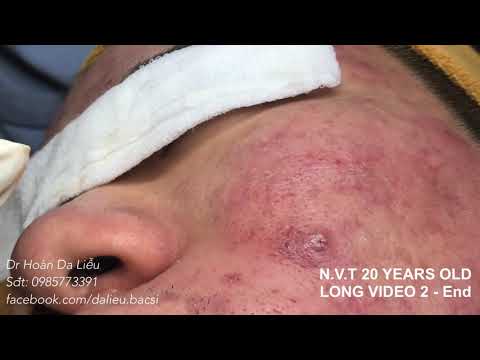 Video Dermatologist treating squeeze pimples,whitehead... - youtube