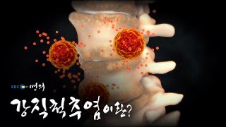 [명의 의학백과📖] 강직척추염이란