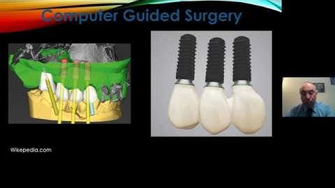 Dr.Alaa (Alan) Yassin Recent Advances in Implant Dentistry