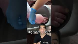 Very Big Blister