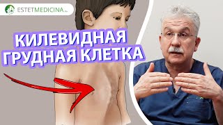 Что такое килевидная деформация и почему она возникает? 📍ЛЕЧЕНИЕ ВЫСТУПАЮЩЕЙ ГРУДНОЙ КЛЕТКИ