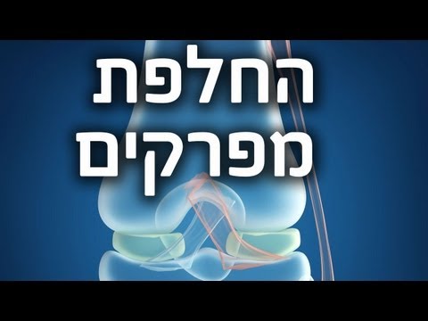 החלפת מפרקים