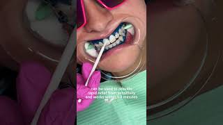 Benefits of Desensitizing before Teeth Whitening #teethwhitening