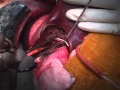 Pericystectomy for Hydatid Cysts of Liver By Dr Hitesh Chavda
