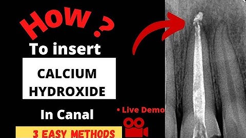 How to Insert Metapex in the Canal | Easy methods| Begginers method | How to use Lentulo Spiral ?