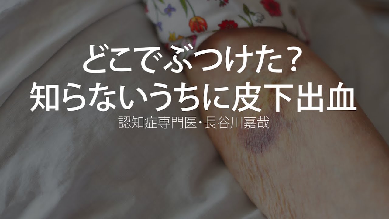 どこでぶつけた？知らないうちに皮下出血〜認知症専門医・長谷川嘉哉