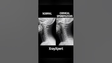 Cervical Spondylosis vs Normal Spine – Dekhiye X-ray me fark! #cervicalstenosis #diskbulge #spine