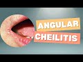 Angular Cheilitis Explained | Causes, Symptoms & Treatment (From A to Z Derma)