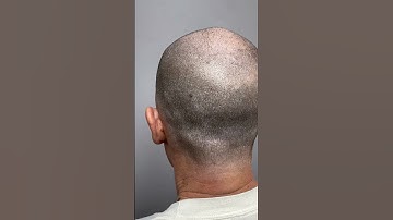 FUE Hair Transplant Scar Camouflage with crown density #northcarolina