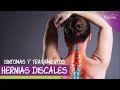 😩 Síntomas y Tratamiento Fisioterapéutico de la Hernia Discal | FISIOLIFE