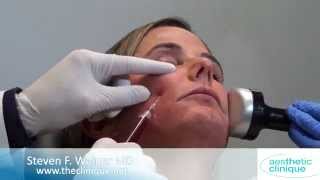 Facial Rejuvenation with PRP Injection \& PPP with Dermapen. Dr. Steven Weiner, Destin, Florida