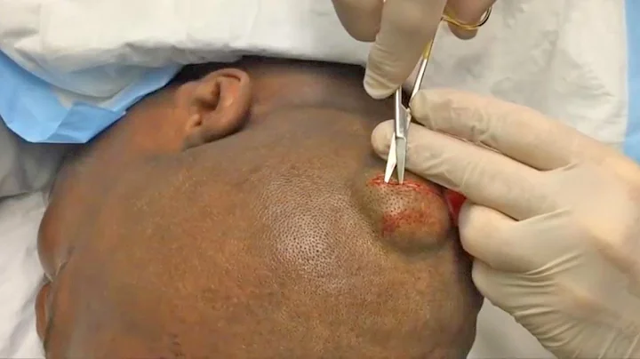 Dr. Gilmore's BANNED Cyst Removal Procedure