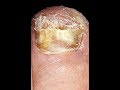 Грибок ногтей простое лечение (инструкция и название под видио в описании)