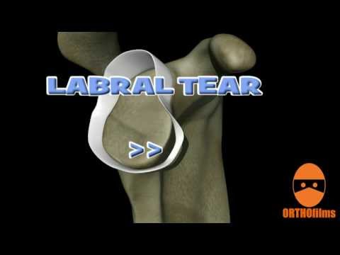 Inestabilidad Del Hombro Y Lesiones De Labrum