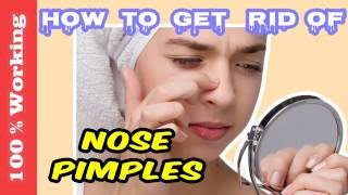 Remedies - blackheads acne remove ...