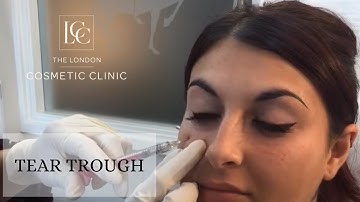 Tear Trough Dermal Filler Treatment