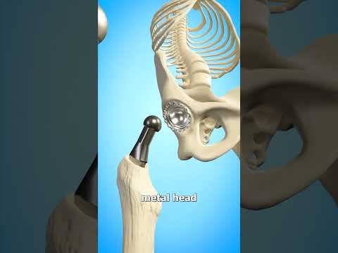 Total Hip Replacement 🤔 (Explained)