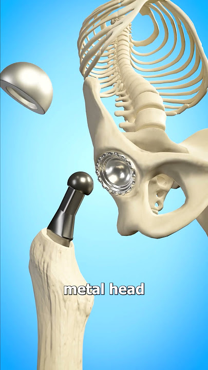 Total Hip Replacement 🤔 (Explained)