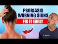 Doctor Explains Warning Signs of Psoriasis &amp; How To Fix It Fast
