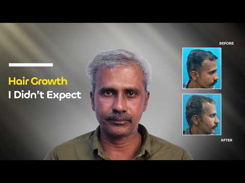 I Was Losing Hair Fast… Watch What Happened Next