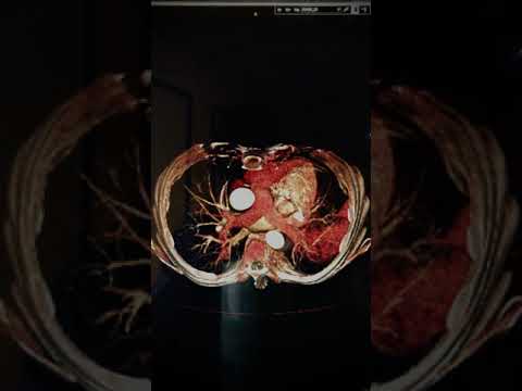 Thoracic Imaging