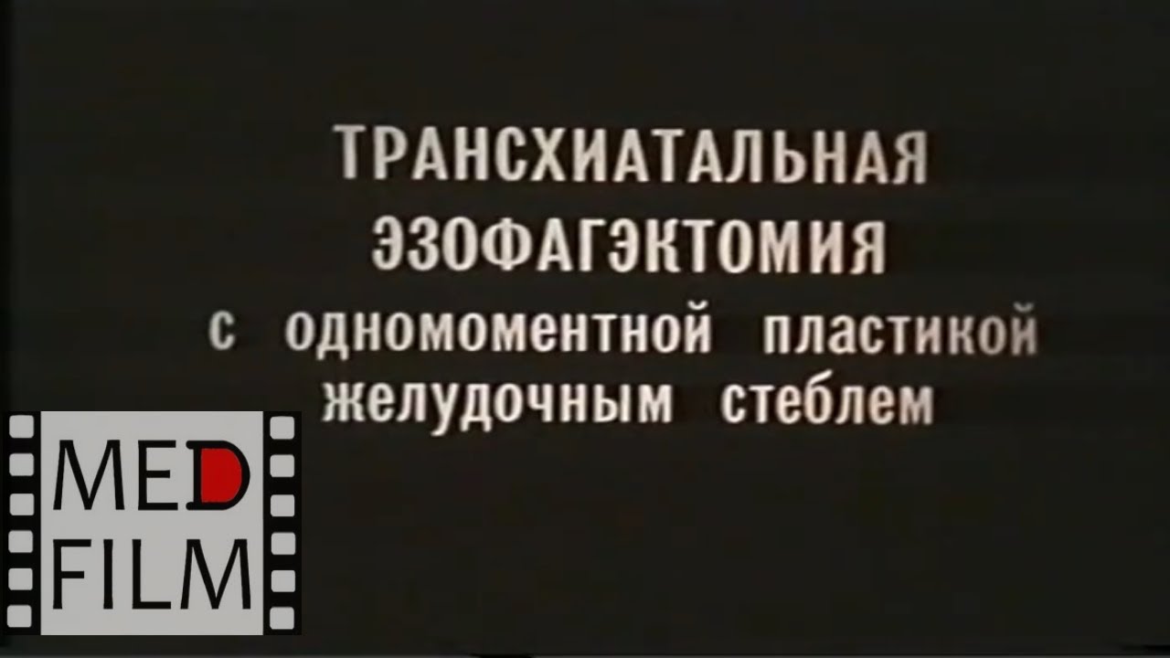 Рак желудка. Трансхиатальная эзофагэктомия © Transchiatal esophagectomy ...