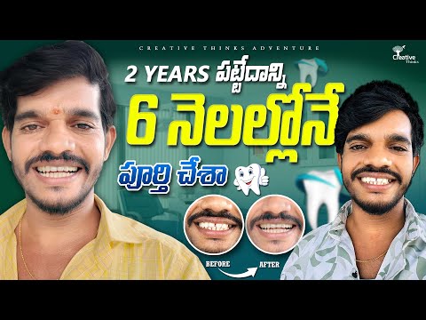 How My Smile Changed in Just 6 Months Before & After 4K | Shree Videos