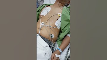 Transcutaneous Pacing (TCP)
