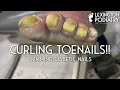 Curling Toenails! Trimming Diabetic Nails