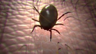 Lyme disease