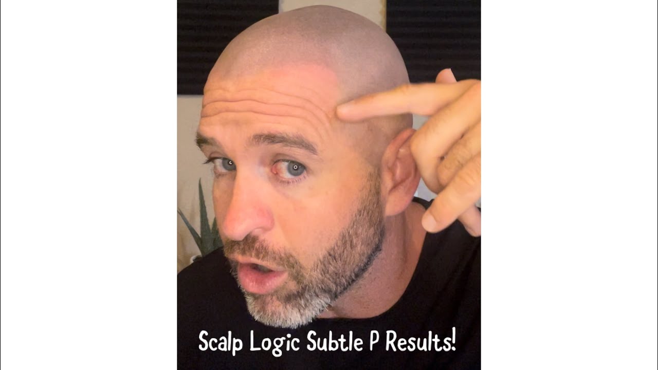 Scalp Logic Journey Subtle Scalp MicroPigmentation scalp_logic YouTube
