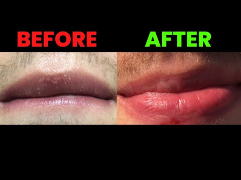 Fordyce spots on lips removal - *NEW UPDATE* [IT WORKS 🙏🙏🙏]
