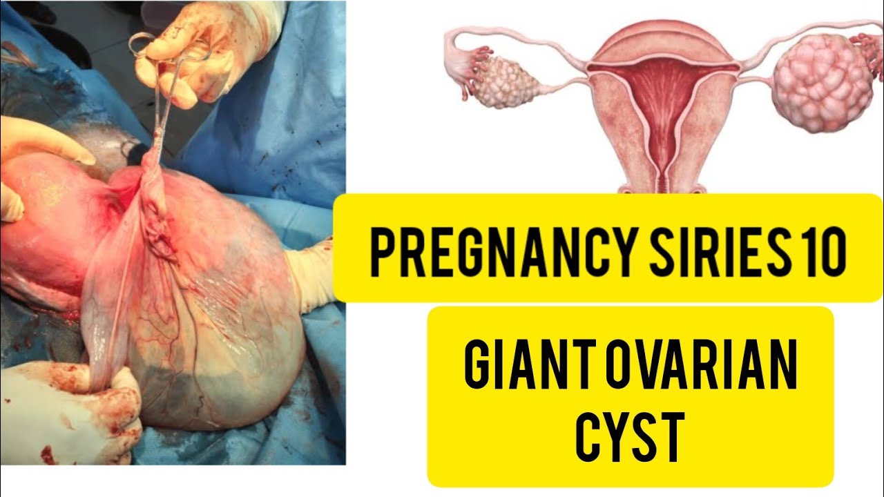 What is Ovarian Cyst healthtalk nursing YouTube