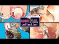 Asmr collection danimations de nettoyage des oreilles cool tingle foot care ongle incarn