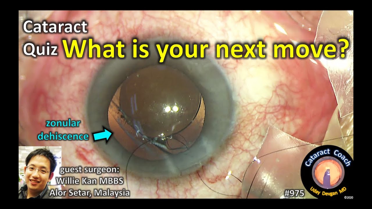 Cataract Quiz Zonular Dehiscence in a traumatic white cataract YouTube