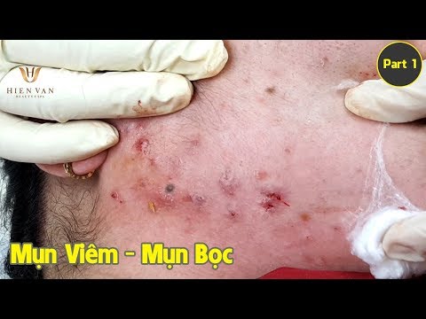 Video Điều trị mụn ẩn - mụn viêm - mụn bọc hiệu quả nhất... - youtube